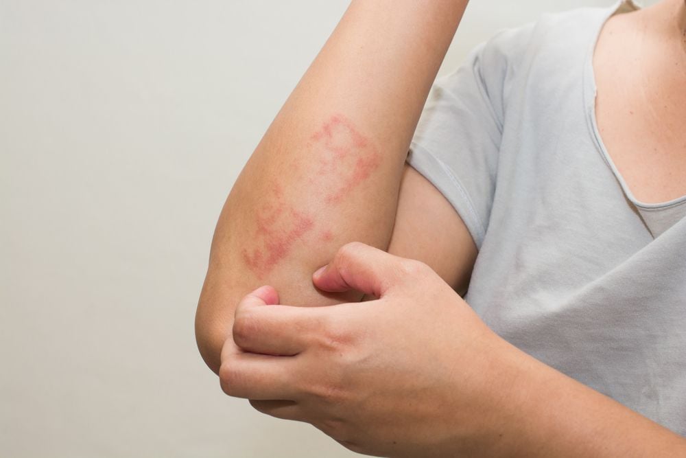 Eczema treatment in Southfield Michigan