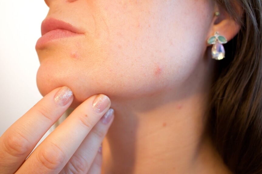 Skin concerns flaring up this fall