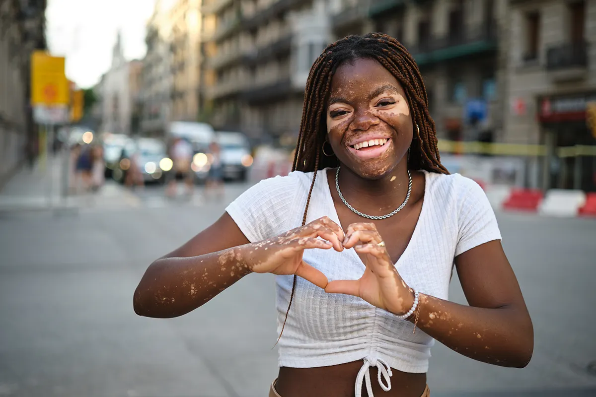 Vitiligo