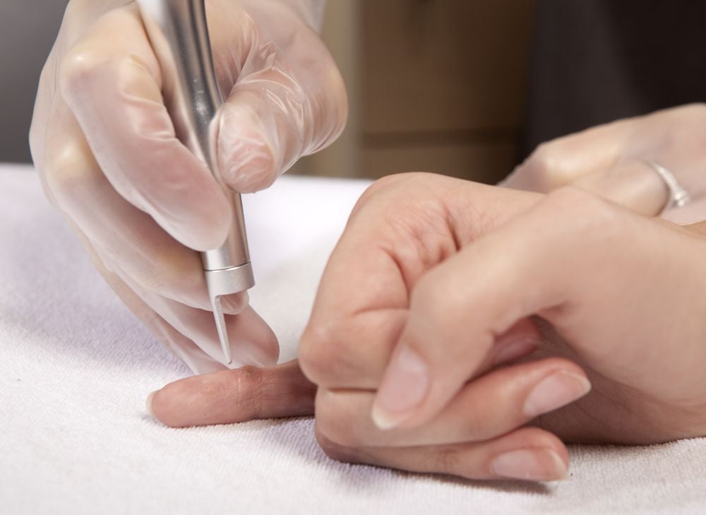 Wart removal in Southfield Michigan