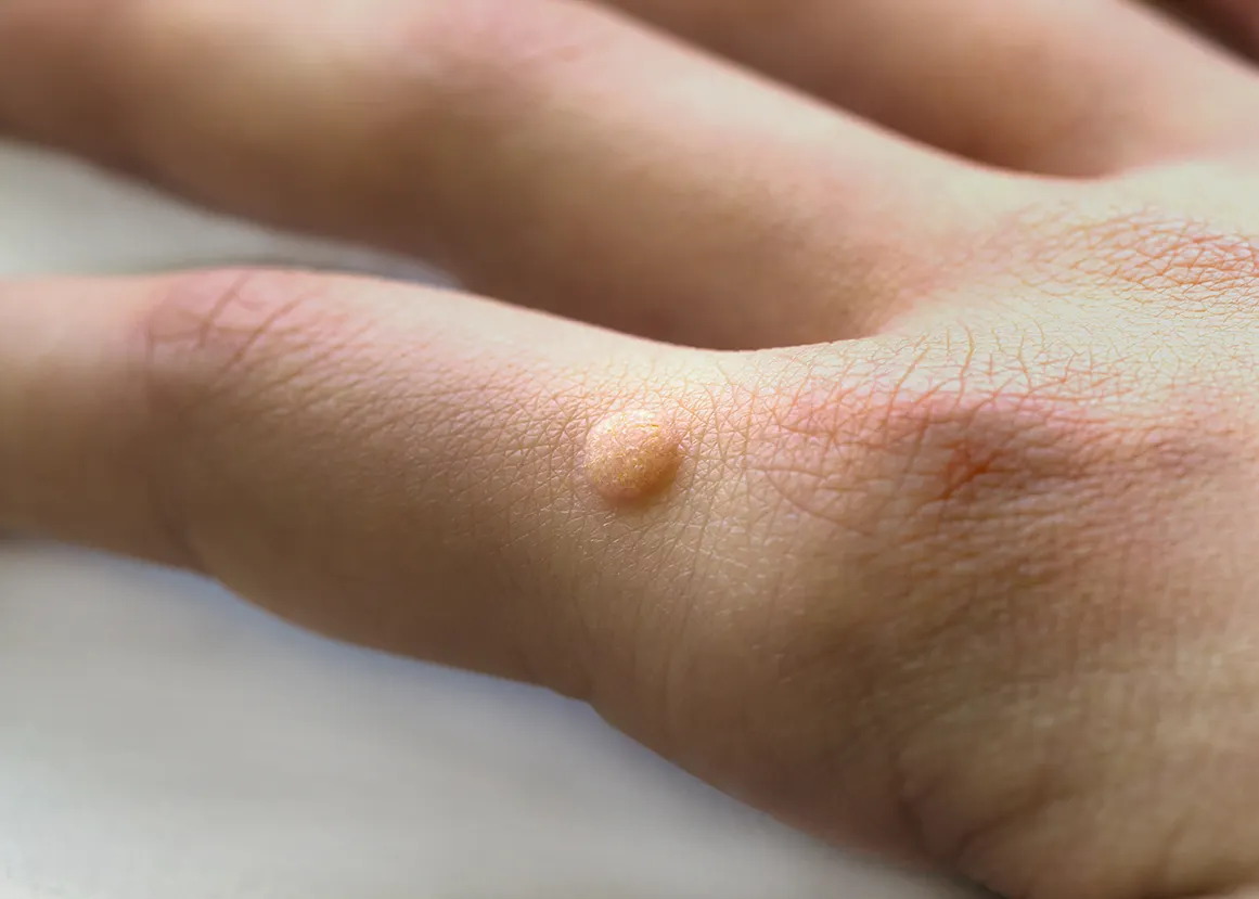 Warts & Plantar Warts