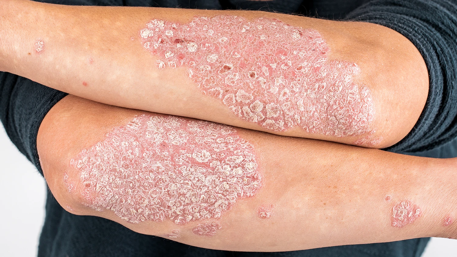 Psoriasis Northwest Dermatology Group in Oakland County