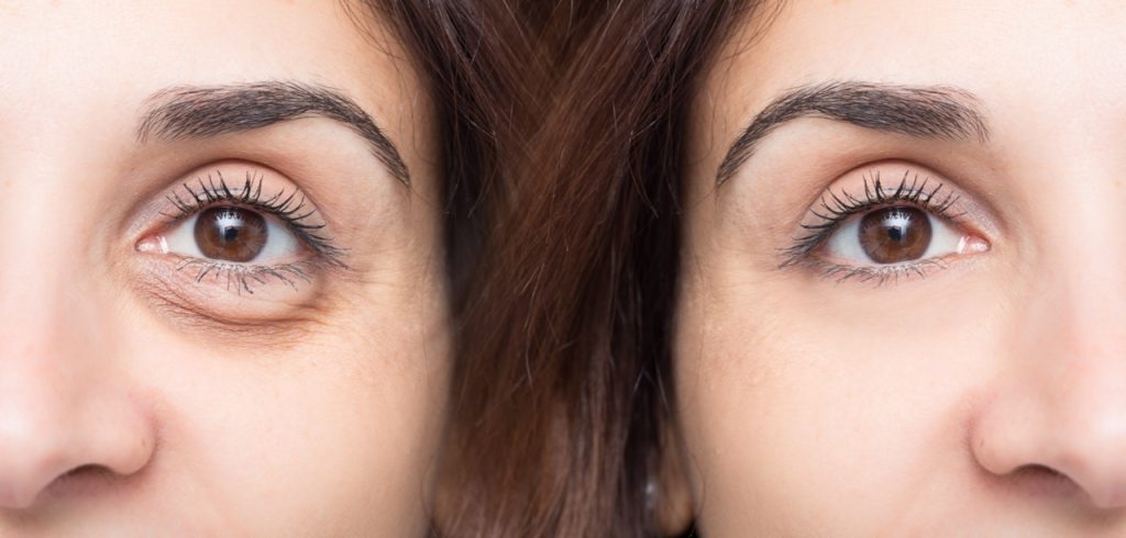 Woman eye before and after cosmetic treatment with and without eye bag