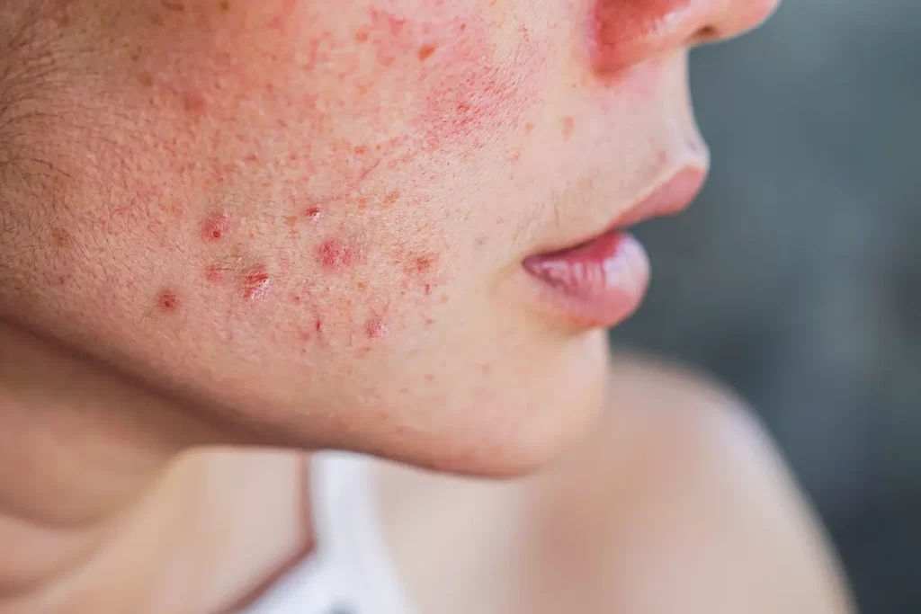 fungal acne, milia and whiteheads northwest dermatology